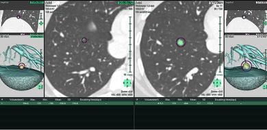 traiter le cancer pulmonaire synapse